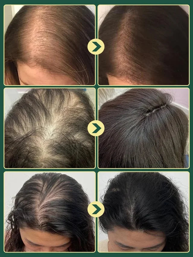 Limited Time🌿Unlock Better Hair with 70% OFF🔥Alcuras® Organic Rosemary Hair Growth Shampoo⚡⚡  [The less hair, the better the effect]